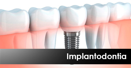 implantodontia